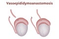 Reconstruction of the vas deferens. Royalty Free Stock Photo